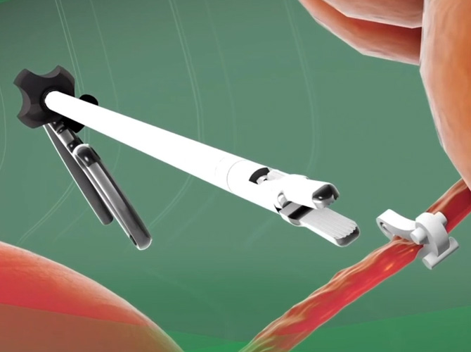 Animation of clip remover